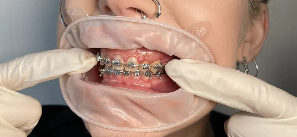 OnlyFans cuenta braces.fetish header 2