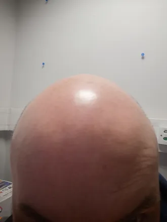 OnlyFans cuenta embracethebald header 2