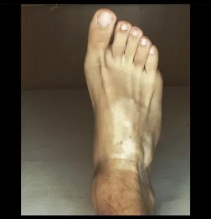 OnlyFans account  vitiligofeets avatar 1