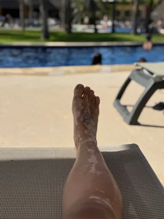 OnlyFans cuenta vitiligo_foot header 2